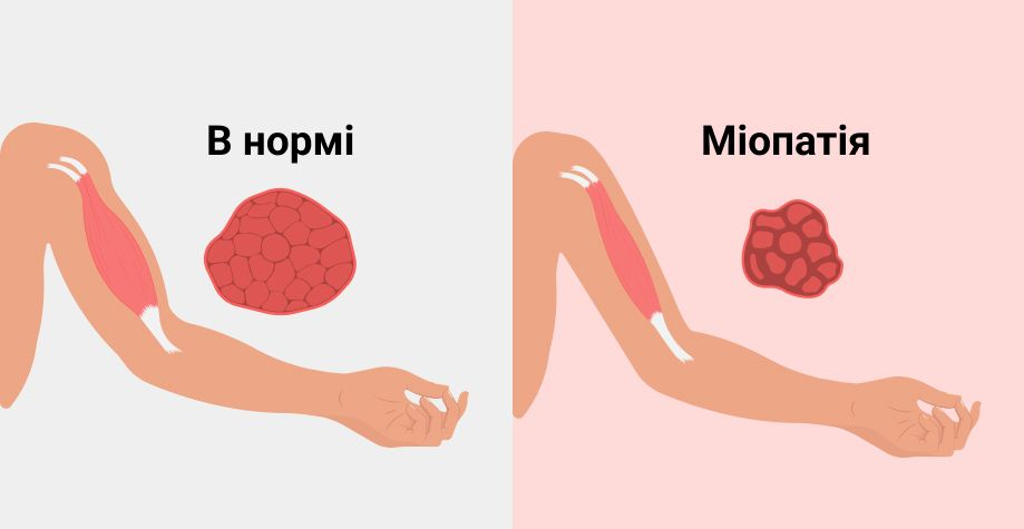 Як проявляється міопатія