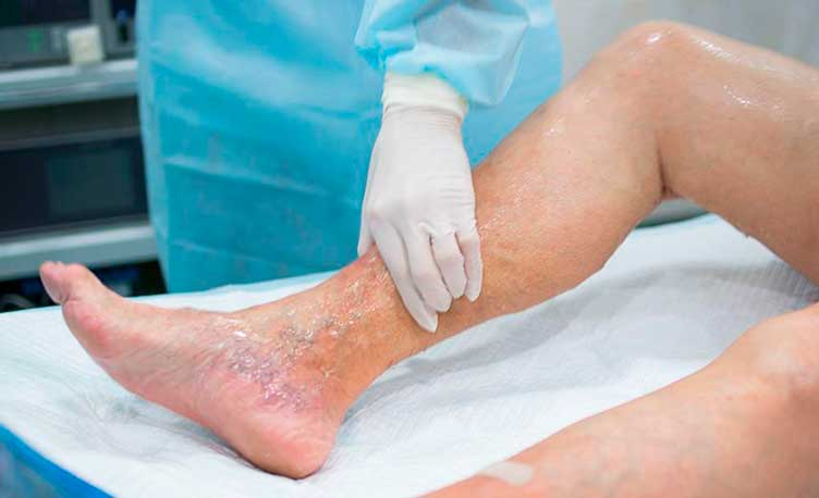 Роль спадковості в розвитку варикозу