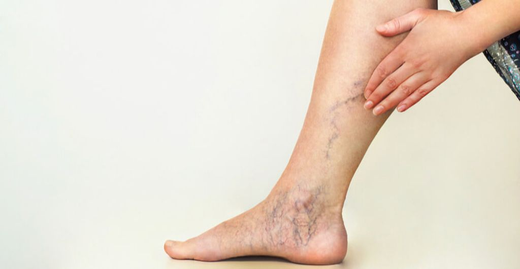 Як проводиться діагностика варикозного розширення вен