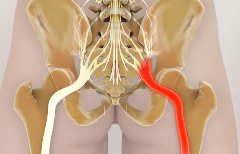 Запалення сідничного нерва
