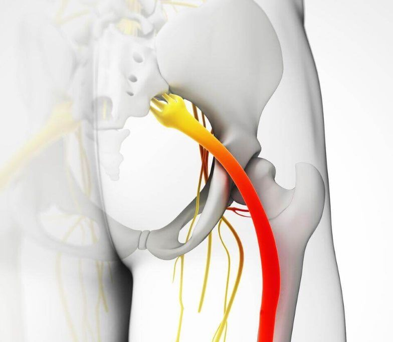 Методи лікування ішіасу