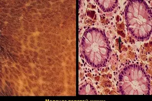 Зв'язок меланозу з проносними препаратами