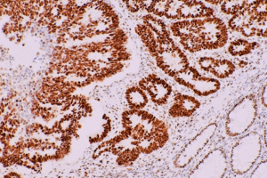 Меланоз кишківника