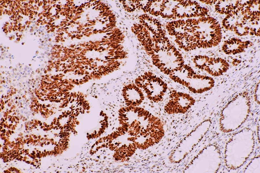 Меланоз кишківника: чи дійсно він пов’язаний з проносними засобами- Фото 1 Меланоз кишківника: чи дійсно він пов’язаний з проносними засобами- Фото 1