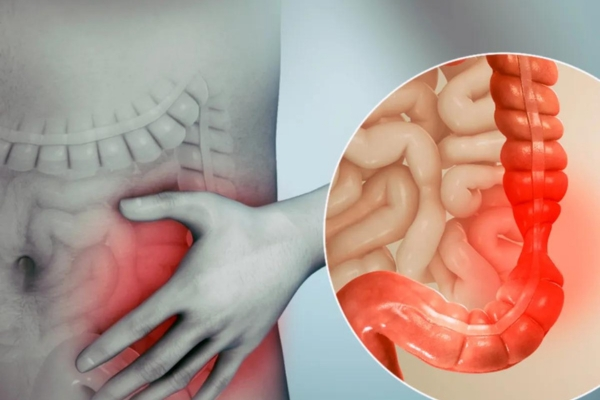 Що таке контактні проносні: чому вони актуальні