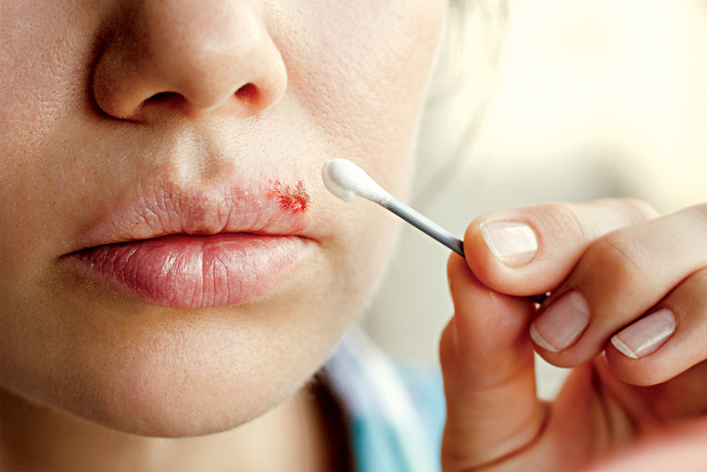 Причини розвитку герпесу