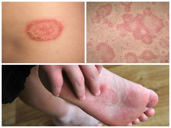 Причини розвитку грибкових інфекцій шкіри