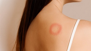 Типи грибкових інфекцій