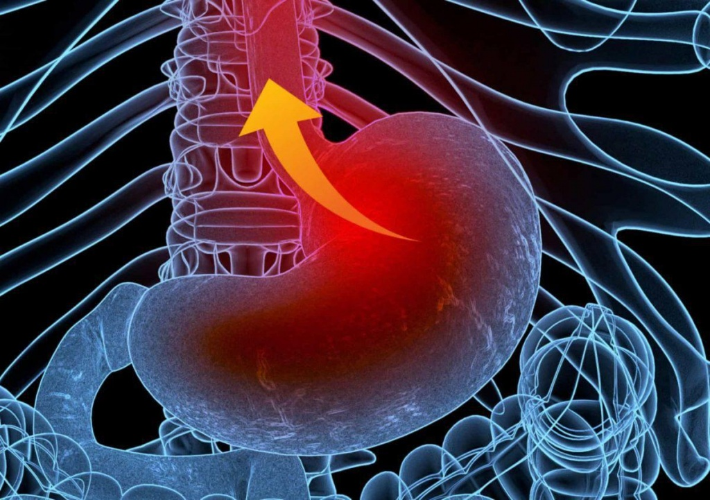 Чому виникає гастроезофагеальна рефлюксна хвороба
