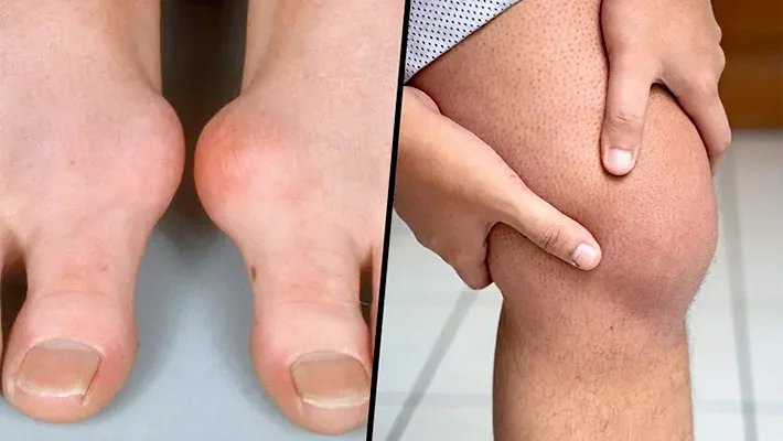 Як проводиться лікування подагри