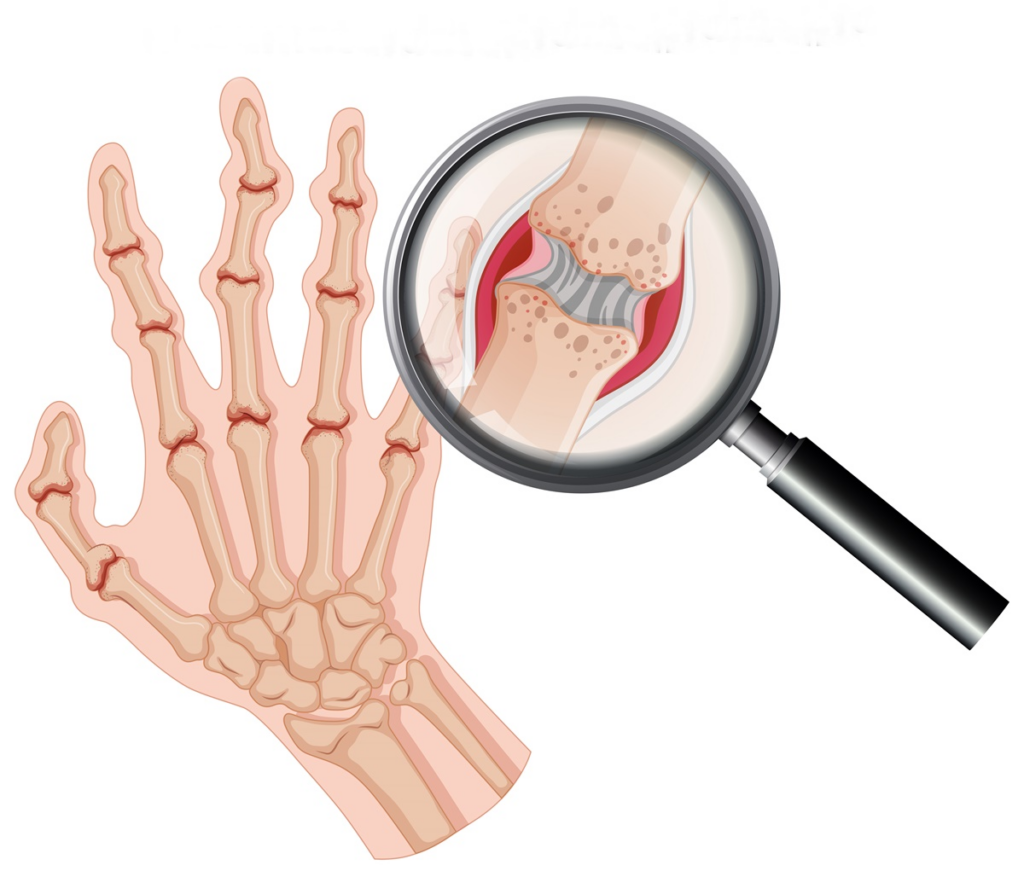 Ревматоїдний артрит: перші симптоми та сучасне лікування- Фото 1